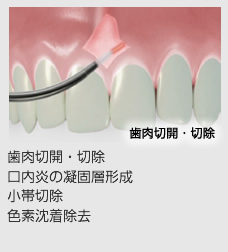 歯肉切開・切除、口内炎の凝固層形成、小帯切除、色素沈着除去